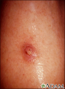 A bluish red discoloration of the overlying skin of the breast and