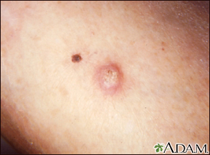 basal cell carcinoma on arm