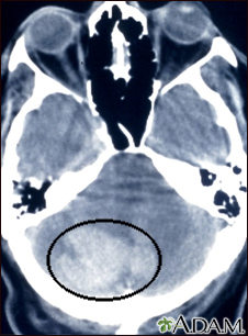 Intracerebellar hemorrhage - CT scan - Illustration Thumbnail
              