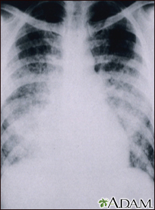 Chickenpox, acute pneumonia - chest X-ray - Illustration Thumbnail
                      