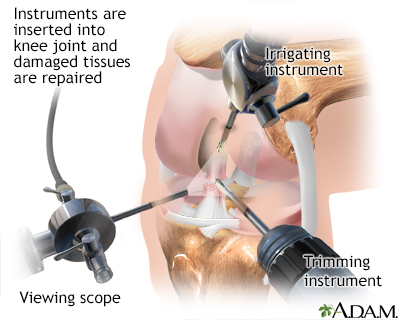 Anterior Cruciate Ligament (ACL) Tear