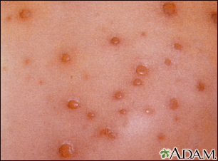 chicken pox pictures in adults