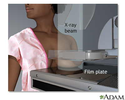 Mammogram - calcifications Information