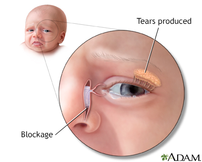 Blocked tear duct - Illustration Thumbnail              