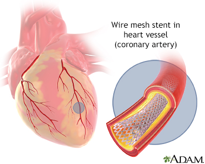 Stent de l'artère coronaire