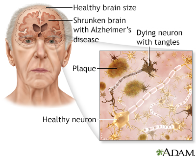 Alzheimer disease - Illustration Thumbnail
                      