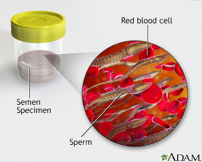 Blood in semen - Illustration Thumbnail
              