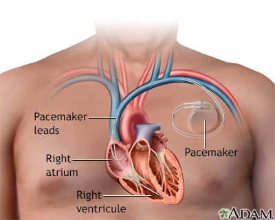 Stimulateur cardiaque