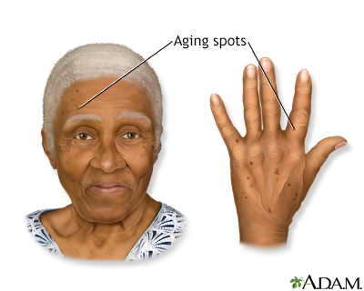 Aging spots - Illustration Thumbnail
              