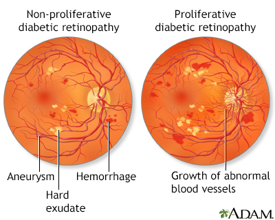 Diabetic neuropathy in the eyes