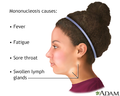 mononucleosis throat