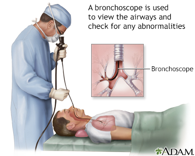 Bronchoscopy - Illustration Thumbnail
                      