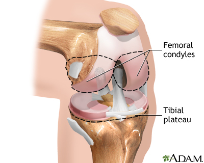 Knee joint replacement Information