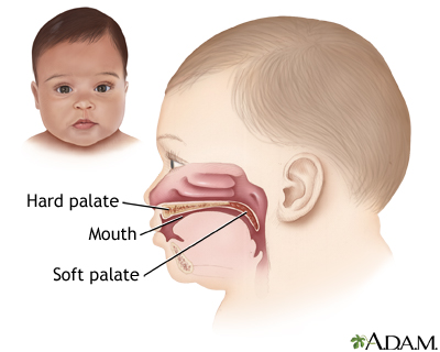 Cleft lip repair - series - Presentation Thumbnail
                    