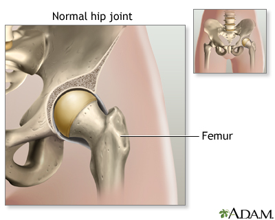 Patients wear down their artificial hips