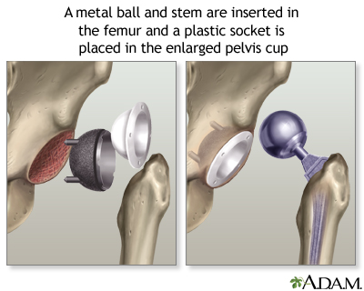 Hip joint replacement Information