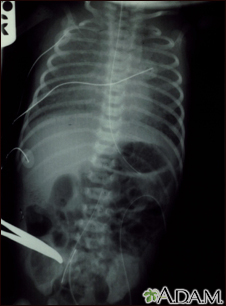 Totally anomalous pulmonary venous return - X-ray - Illustration Thumbnail
                      