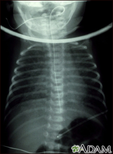 Totally anomalous pulmonary venous return - X-ray - Illustration Thumbnail
                      