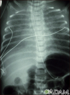 Totally anomalous pulmonary venous return - X-ray - Illustration Thumbnail              