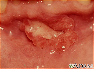 Canker sore (aphthous ulcer) - Illustration Thumbnail              