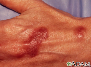 Mycobacterium marinum infection on the hand - Illustration Thumbnail