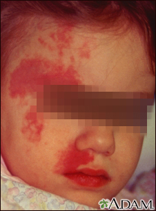 Port wine stain on a child's face - Illustration Thumbnail
              