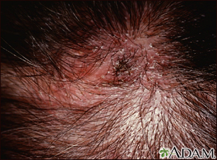 ringworm in humans on head