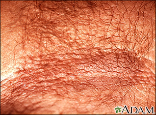 Acanthosis nigricans - close-up - Illustration Thumbnail
                      