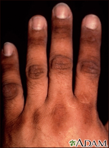 Acanthosis nigricans on the hand - Illustration Thumbnail
              