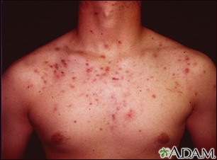 female chest acne