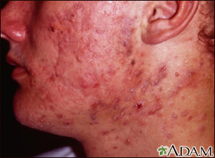 Acne - cystic on the face