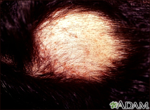 Alopecia areata. Non-inflammatory circular patch of hair loss on the... |  Download Scientific Diagram