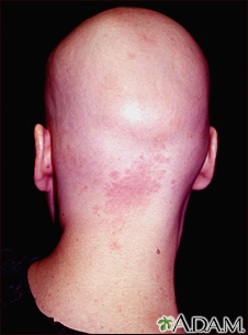 Alopecia totalis - back view of the head - Illustration Thumbnail              