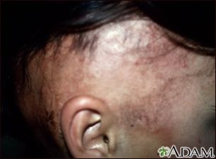 Alopecia Areata Information Mount Sinai New York