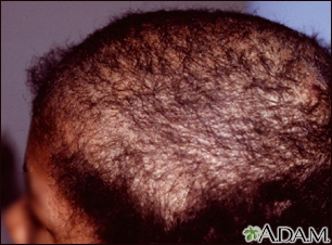 Types of Disease That Cause Hair Loss Manhattan, NYC - The Hair