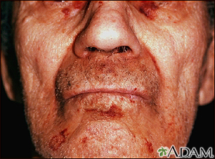 Amyloidosis of the face - Illustration Thumbnail
              