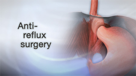 Anti-reflux surgery