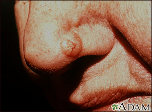 Skin cancer, basal cell carcinoma - nose - Illustration Thumbnail
              