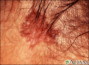 Skin cancer, basal cell carcinoma - pigmented