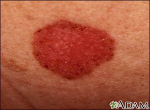 Skin cancer, basal cell carcinoma - spreading