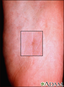 nevoid basal cell carcinoma syndrome