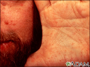 Basal cell nevus syndrome - face and hand - Illustration Thumbnail
              