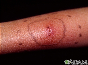 RED RASHES ON THE SKIN? READ THIS INFORMATIVE DEEP-DIVE