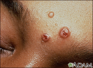 Cryptococcosis on the forehead - Illustration Thumbnail
                      