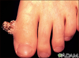 common warts on feet