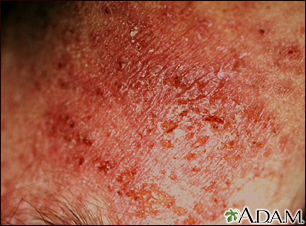 Dermatitis - close-up of allergic contact
