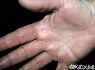 Hyperlinearity in atopic dermatitis - on the palm - Illustration Thumbnail
              