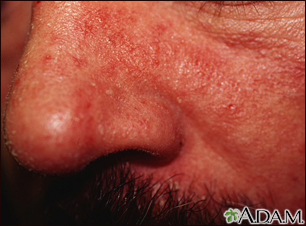 Dermatitis seborrheic - close-up