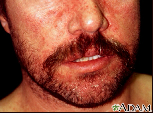 How to Take Care of Seborrheic Dermatitis Under Beards