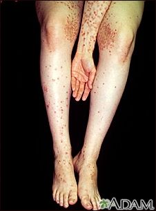 dermatitis herpetiformis elbow